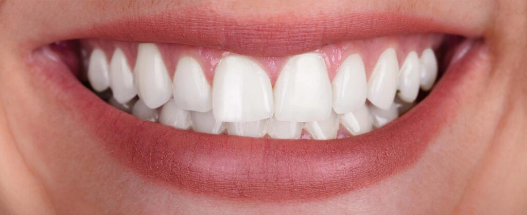 Teeth Whitening at Piedmont Dental in Rock Hill, SC